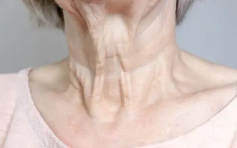 Primer plano del cuello flácido de una mujer mayor, mostrando arrugas y pliegues pronunciados.