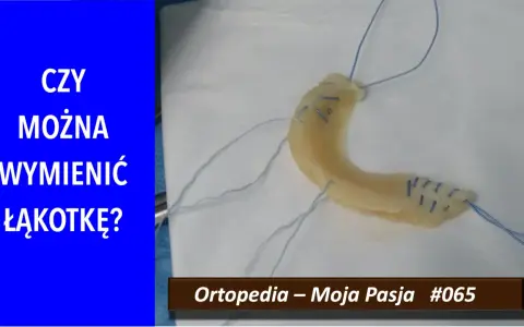 Implant łąkotki NFZ. Czy można wymienić łąkotkę? Ortopedia – Moja Pasja #065.
