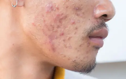 Gros plan sur le visage d'un homme présentant une acné sévère, avec des rougeurs et des pustules visibles sur la joue et le menton.
