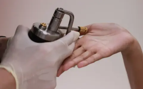 Application d'azote liquide sur une verrue pour un traitement par cryothérapie.