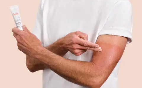 Un homme applique la crème Cicalfate+ sur son bras irrité, peut-être atteint de psoriasis, pour apaiser et réparer sa peau.