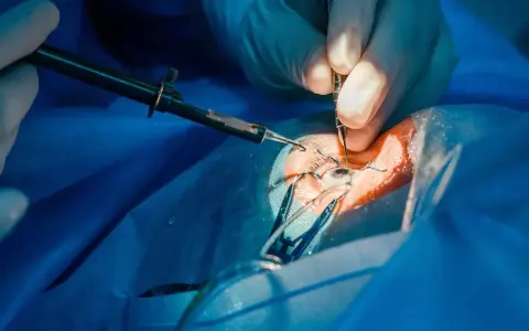 Dettaglio di un intervento glaucoma con tubicino, mani guantate usano strumenti chirurgici sull'occhio.