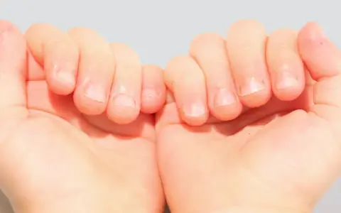 Mains d'enfant montrant des ongles rongés, avec des cuticules irrégulières et des bords d'ongles abîmés.