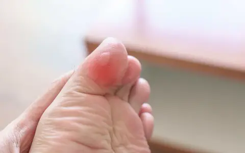 Pie de niño con ampolla roja en el dedo gordo, resultado de largas caminatas o juegos.