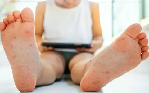Małe czerwone kropki na stopach dziecka, które mogą wskazywać na wysypkę. Dziecko siedzi, trzymając tablet.