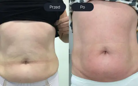 Porównanie brzucha przed i po endermologii. Widoczne wygładzenie skóry i redukcja tkanki tłuszczowej – spektakularne endermologia brzuch efekty.