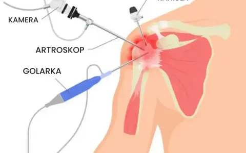 Endoproteza barku NFZ - Jak uniknąć pułapek i dopłat?