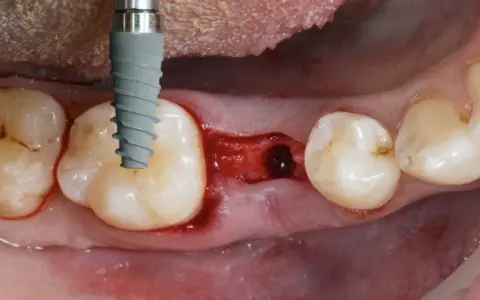 Kiedy implant po wyrwaniu zęba? Poznaj kluczowe terminy i ryzyka