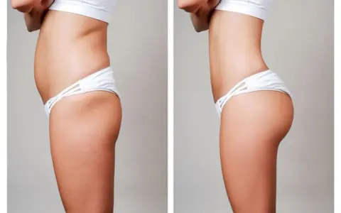 Liposukcja: Kompleksowy przewodnik po zabiegu i kosztach w Polsce