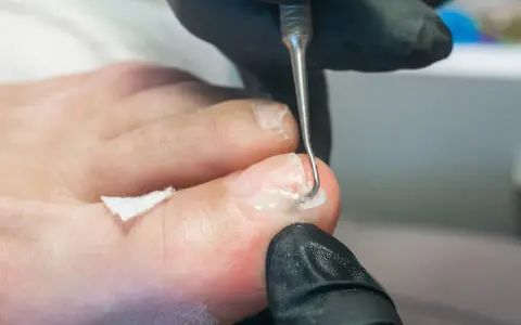 Prise en charge podologue diabète : un professionnel utilise un instrument pour nettoyer délicatement un ongle de pied, assurant des soins essentiels.