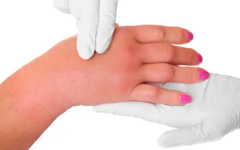 Mani gonfie dopo camminata, con dita arrossate e gonfie. Un guanto bianco esamina il gonfiore.