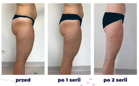Efekty zabiegu iCoone na uda: przed, po 1 i po 2 seriach. Widoczna redukcja cellulitu i poprawa jędrności skóry.