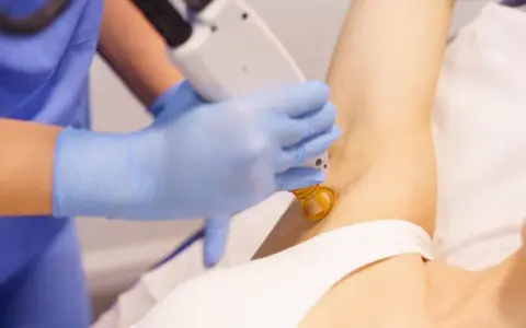Depilacja laserowa: czy boli? Poznaj prawdę i metody łagodzenia bólu
