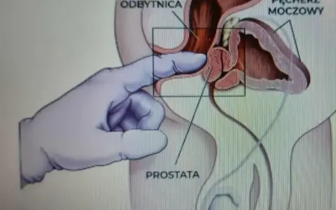 Ilustracja medyczna pokazująca palec w rękawiczce wykonujący masaż prostaty przez odbytnicę.