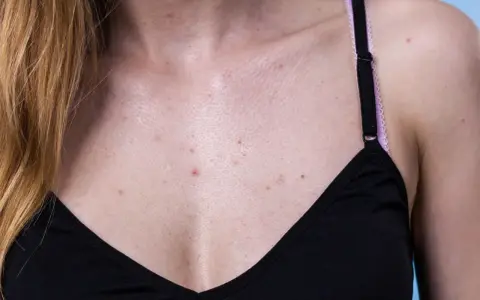 Pickel am Dekolleté können auf hormonelle Schwankungen hinweisen. Die Haut zeigt Rötungen und kleine Unreinheiten.