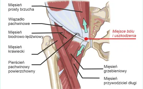 Anatomia pachwiny z zaznaczonym miejscem bólu i uszkodzenia, gdzie mięsień przywodziciel długi może być narażony.