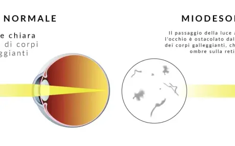 Confronto occhio normale e miodesopsia: corpi galleggianti nel vitreo ostacolano la luce. Ricerca cure naturali per il distacco del vitreo.