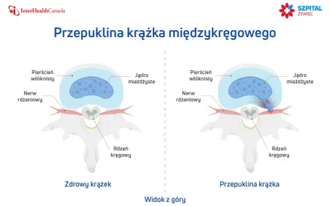 Porównanie zdrowego krążka międzykręgowego z przepukliną krążka szyjnego z uciskiem na worek oponowy.