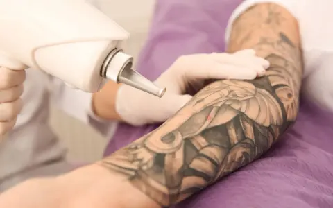 Ręka w rękawiczce trzyma laser do usuwania tatuażu z ręki.
