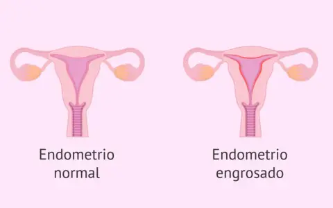 Comparación visual de un útero con endometrio normal y otro con endometrio engrosado, indicativo de hiperplasia endometrial.