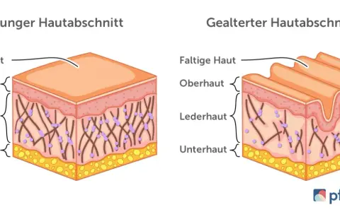 Vergleich von junger, glatter Haut und gealterter, faltiger Haut. Die Lederhaut zeigt bei trockene Haut im Alter weniger Kollagenfasern.