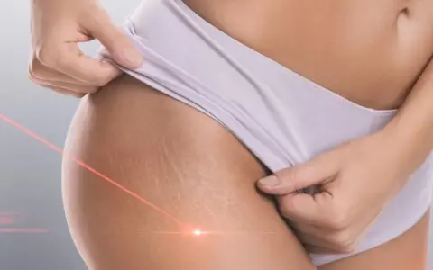 Skóra z widocznymi rozstępami, na którą skierowane są czerwone linie lasera. Zabieg laserowe usuwanie rozstępów.