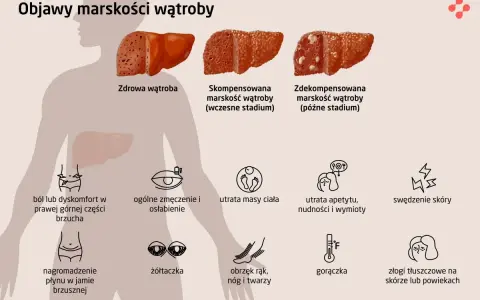 Ilustracja pokazuje zdrowe i chore wątroby, a także objawy marskości wątroby: ból brzucha, zmęczenie, utratę masy ciała, żółtaczkę, obrzęki, gorączkę i zmiany skórne.