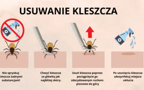 Kleszcz: Wyciągnij, nie wykręcaj! Prawidłowa instrukcja krok po kroku