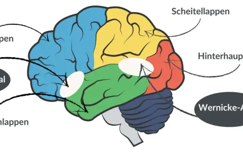 Gehirn mit farbigen Lappen und Markierungen für Broca-Areal und Wernicke-Areal, wichtig für das Verständnis von Broca-Wernicke-Aphasie.