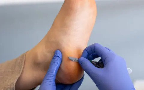 Un podologue enlève une callosité au pied avec un scalpel.