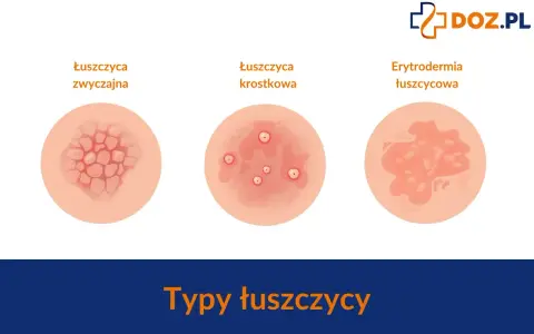 Ilustracja pokazuje trzy typy łuszczycy: zwyczajną, krostkową i erytrodermię łuszczycową.