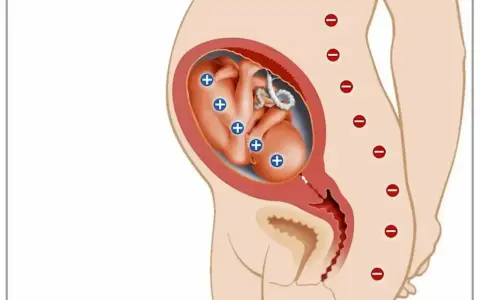 Ilustracja pokazuje płód w macicy z oznaczeniami "+" na ciele, co symbolizuje konflikt serologiczny. Matka ma oznaczenia "-" na kręgosłupie.