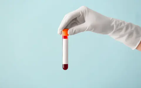 Ręka w białej rękawiczce trzyma probówkę z czerwoną próbką krwi, gotową do analizy, która może wykazać poziom immunoglobuliny.