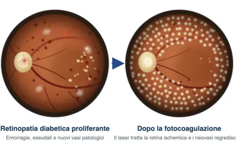 Retinopatia diabetica proliferante con emorragie e essudati, prima e dopo il trattamento laser che riduce la lesione retinica.