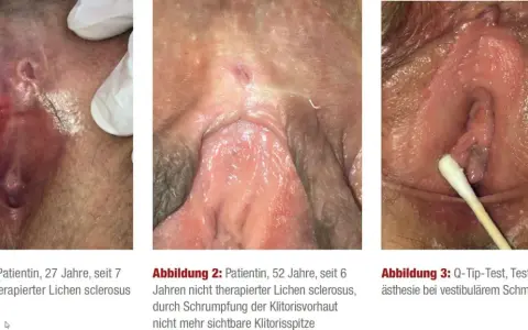 Drei Bilder zeigen die Auswirkungen von Lichen sclerosus: eine entzündete Vulva, eine geschrumpfte Klitoris und einen Q-Tip-Test.