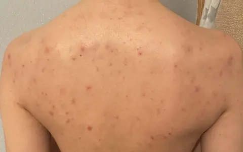 Rygg med utslag av akne på kroppen. Röda prickar och fläckar syns över hela ryggen.