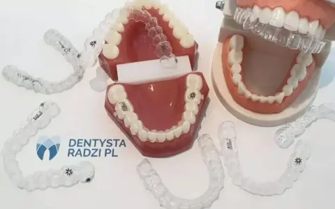Przezroczyste nakładki prostujące zęby na modelach szczęk pokazują potencjalne efekty leczenia ortodontycznego.