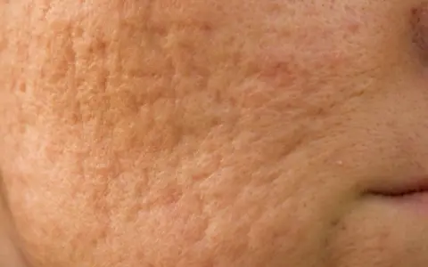 Jak szybko zagoić ranę po pryszczu i uniknąć blizn na skórze