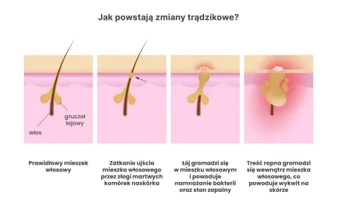 Ilustracja pokazuje powstawanie zmian trądzikowych: zatkanie mieszka włosowego, namnażanie bakterii i stan zapalny. Domowe sposoby na trądzik młodzieńczy mogą pomóc.