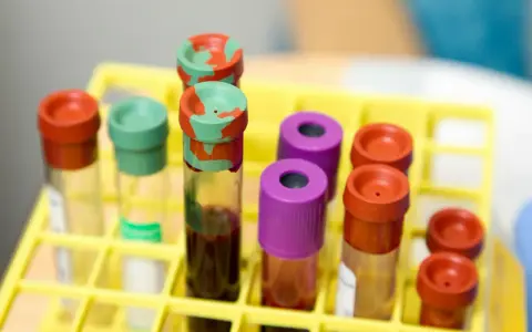 Probówki z krwią w żółtym stojaku laboratoryjnym.