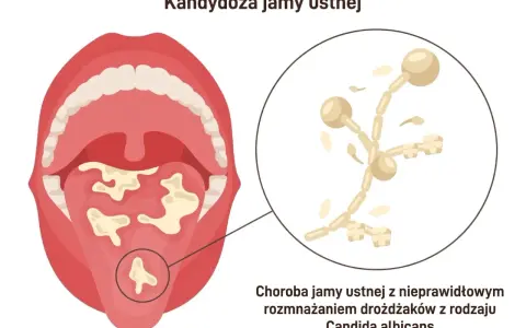 Grzybica jamy ustnej po antybiotyku: białe naloty na języku i podniebieniu, powiększenie drożdżaków Candida albicans.