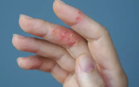 Dedos con piel irritada y escamosa, indicando un fuerte picor en las manos.