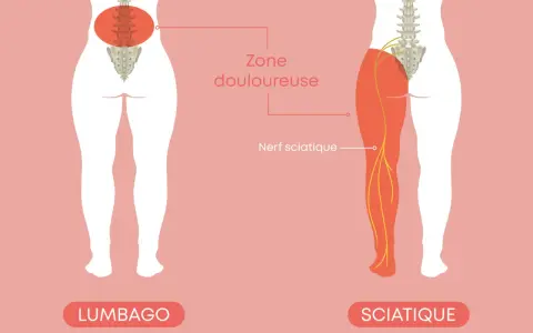 Illustration comparant le lumbago et la sciatique. La sciatique, combien de temps dure-t-elle ? Le nerf sciatique est montré irradiant dans la jambe.