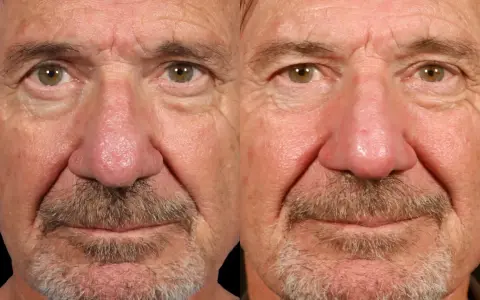 Gros plan sur le visage d'un homme, montrant les effets de la rosacée phymateuse sur son nez et ses joues.