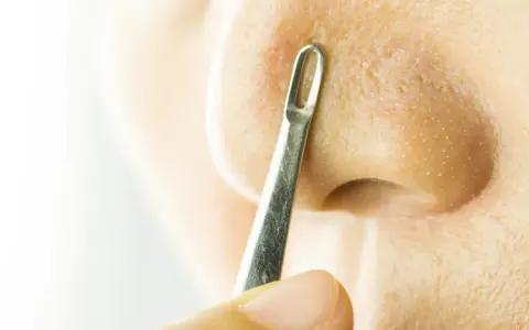 Un outil métallique est utilisé pour extraire un comédon fermé sur le nez.