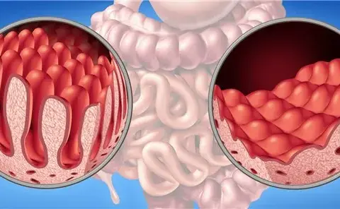 Zöliakie Diagnostik: So vermeiden Sie Fehldiagnosen und Schmerzen