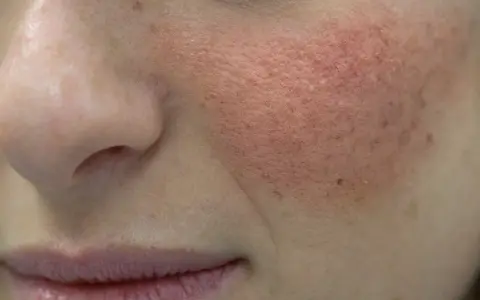 Primo piano del viso con evidente pelle seborroica, arrossamento e pori dilatati sulla guancia.