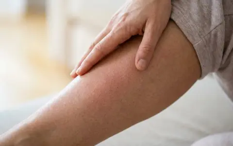 Eine Hand streicht über ein Bein mit geröteter, schuppiger Haut. Das Jucken der beine beim laufen ist deutlich zu spüren.