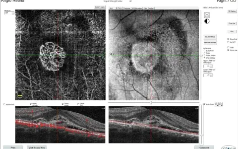 Immagine OCT di un occhio destro, mostra un ispessimento retinico con neovascolarizzazione coroideale, possibile causa di problemi visivi.