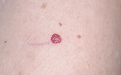 Piel con varios lunares rojos de diferentes tamaños, algunos pequeños y otros más prominentes, junto a finas venas.
